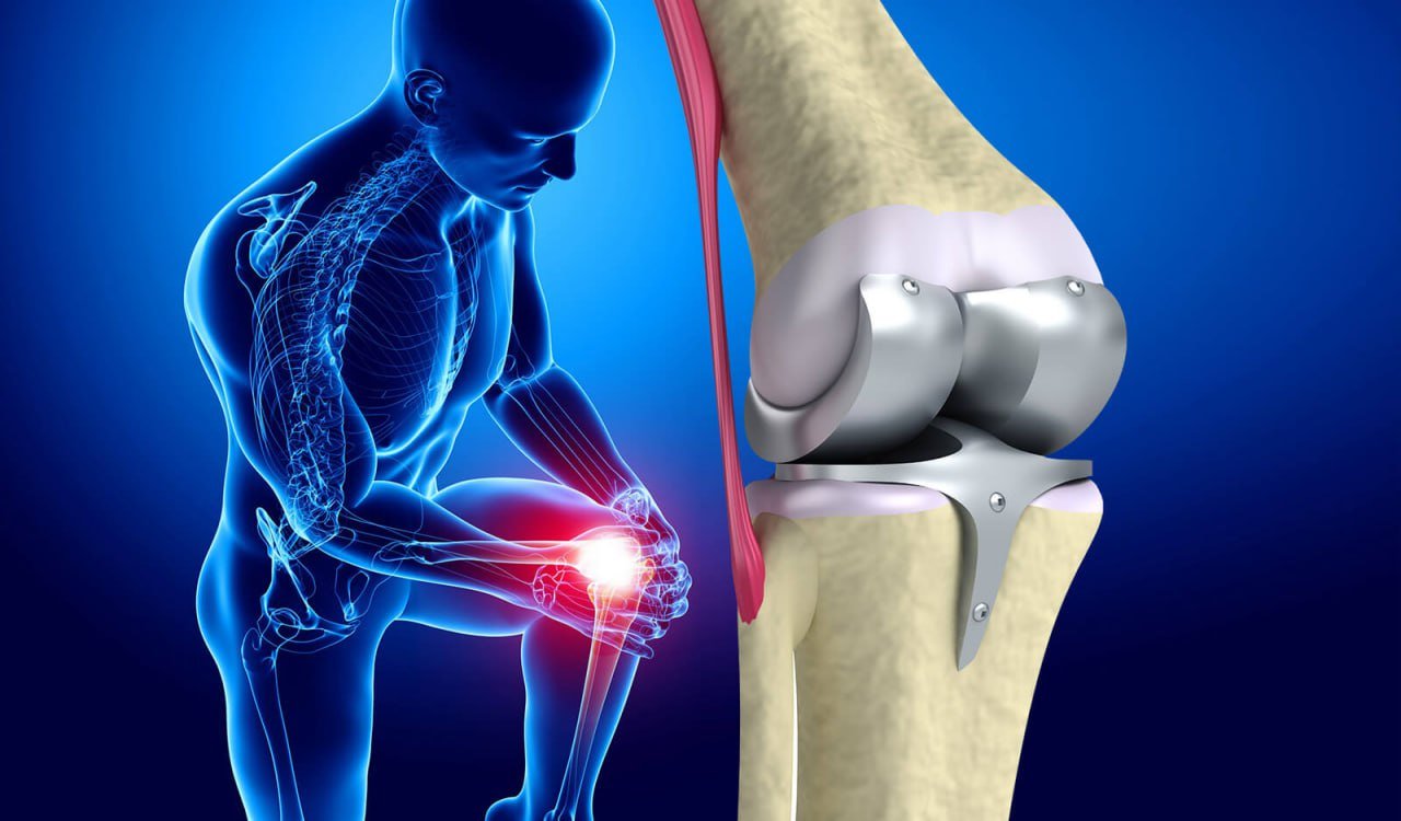 Joint Replacement