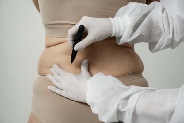 Tummy Tuck vs. Liposuction